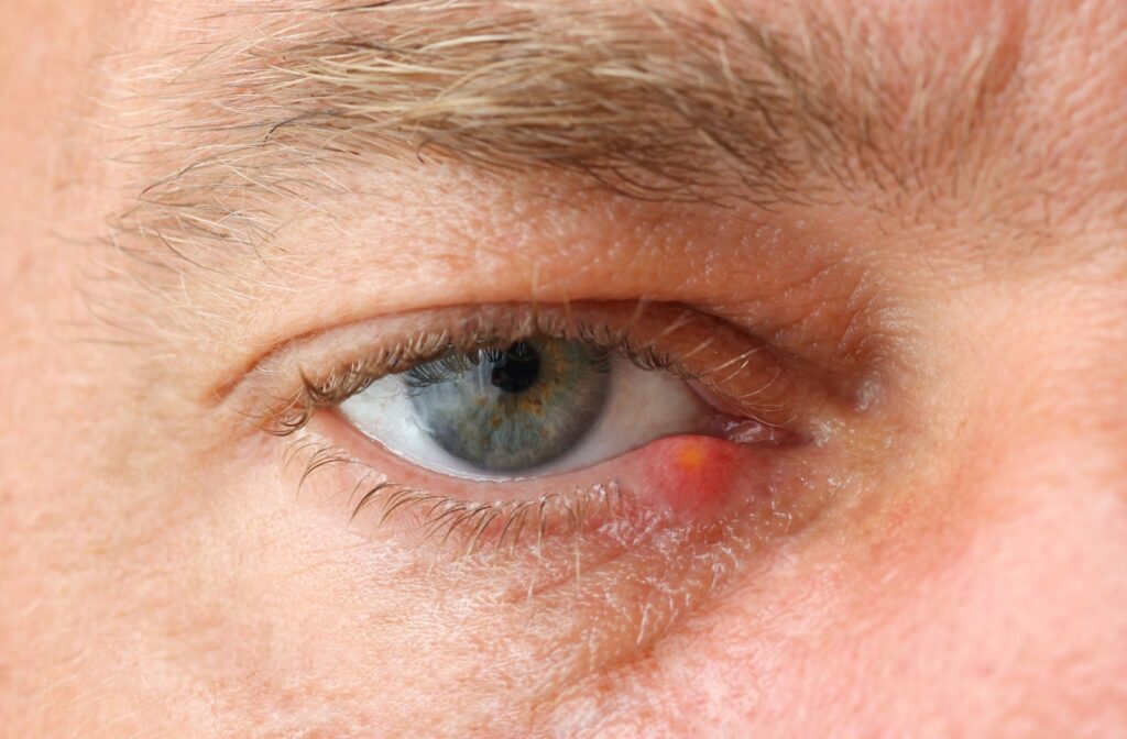 A close-up image of an uncomfortable-looking stye on a person's lower eyelid.