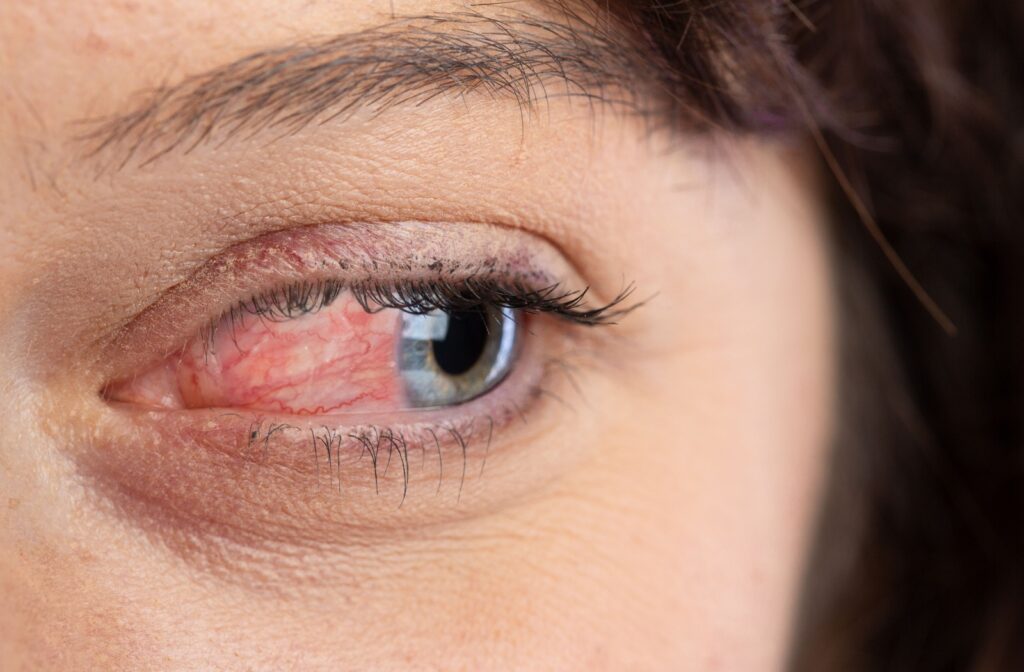 A close-up of a woman's eye, experiencing ocular rosacea symptoms.