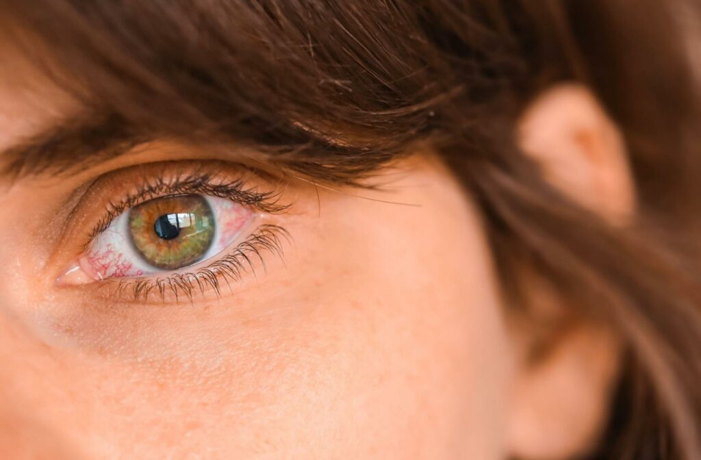 A close up of a red irritated eye caused by dry eye syndrome.